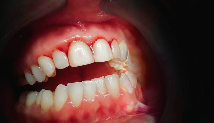 bleeding gums causes