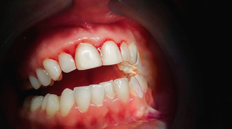 bleeding gums causes