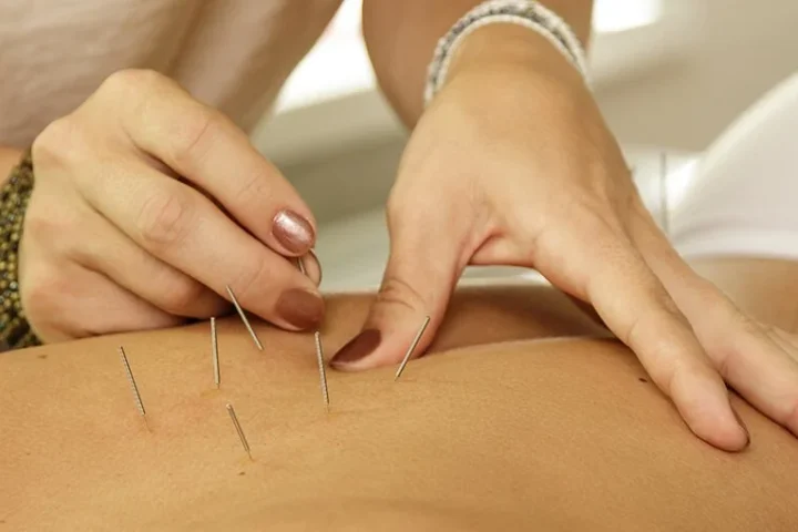 acupuncture for pain relief