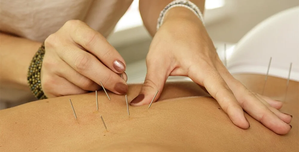acupuncture for pain relief