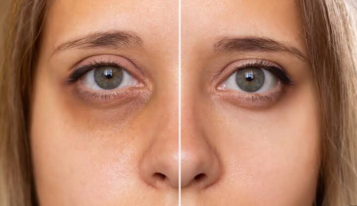 dark circles home remedies