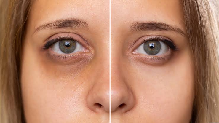 dark circles home remedies